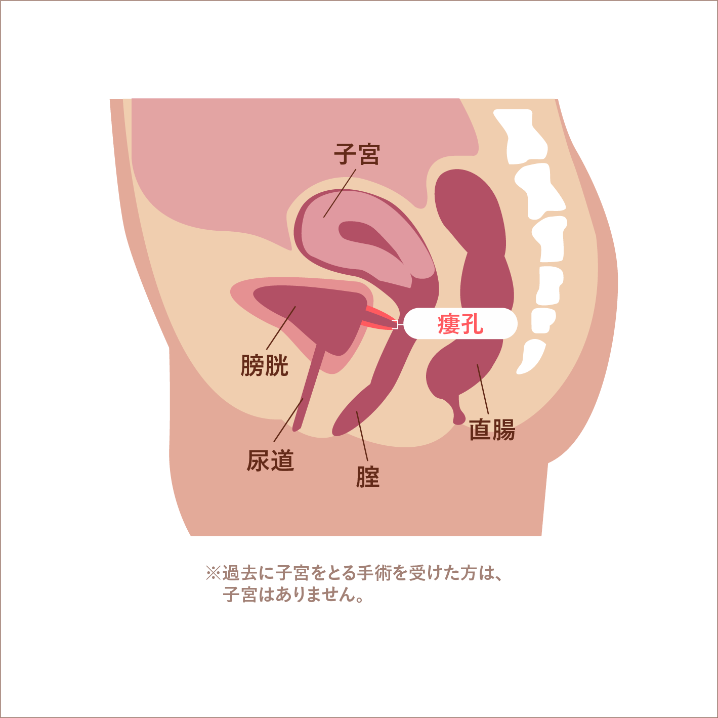 膀胱腟瘻について